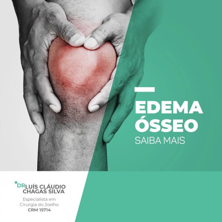 Edema Ósseo – Saiba Mais – Drº Luis CLaudio Chagas – Especialista em Joelho